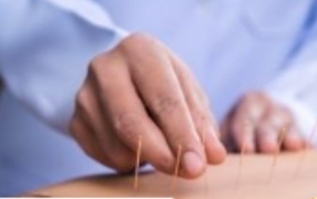 Dry Needling